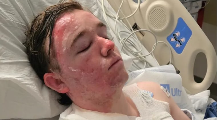 Jacob Smith recovers in the UC Davis ICU burn unit after police say a coworker at a McDonald's in Yuba City, Calif., threw hot liquid on him.